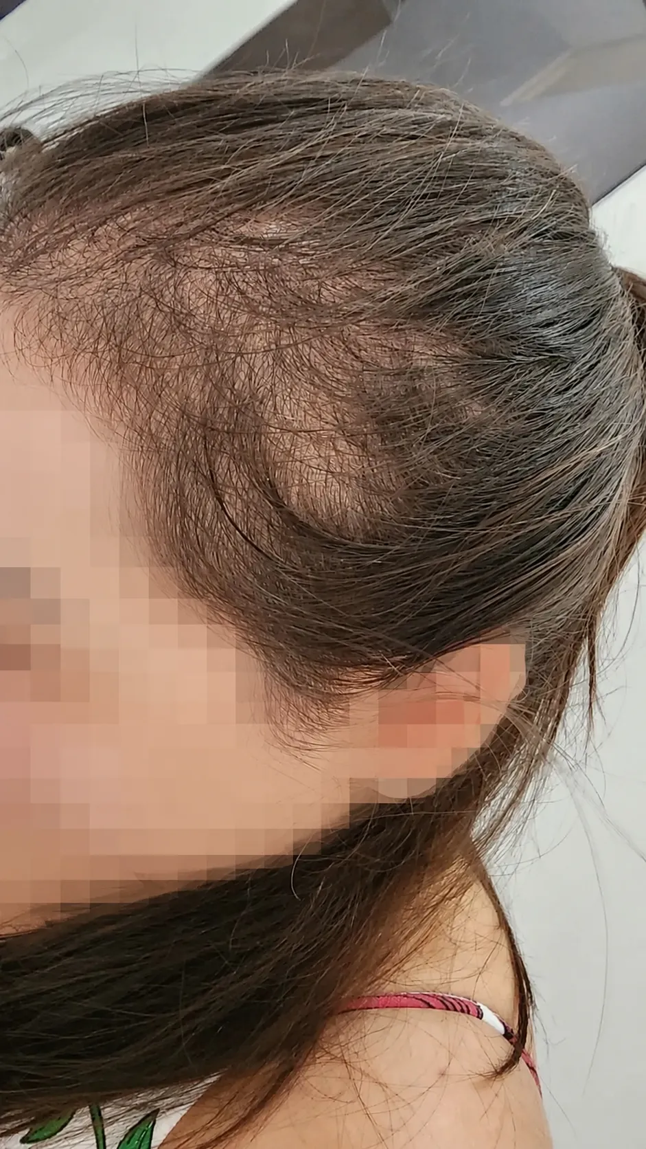 Caso 03 — antes do tratamento para região frontal e lateral com rarefação