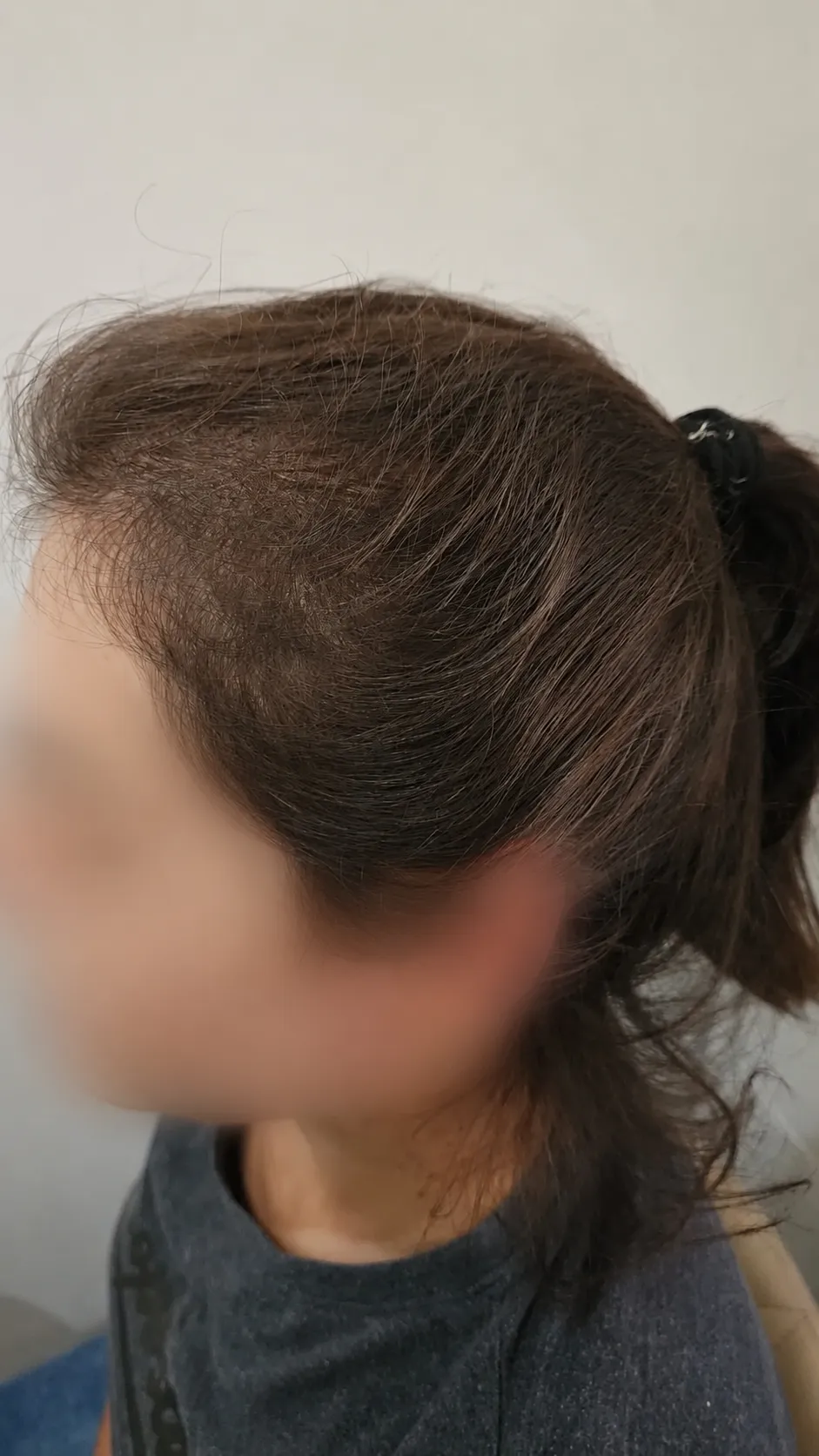 Caso 03 — depois do tratamento com densidade recuperada na região frontal e lateral