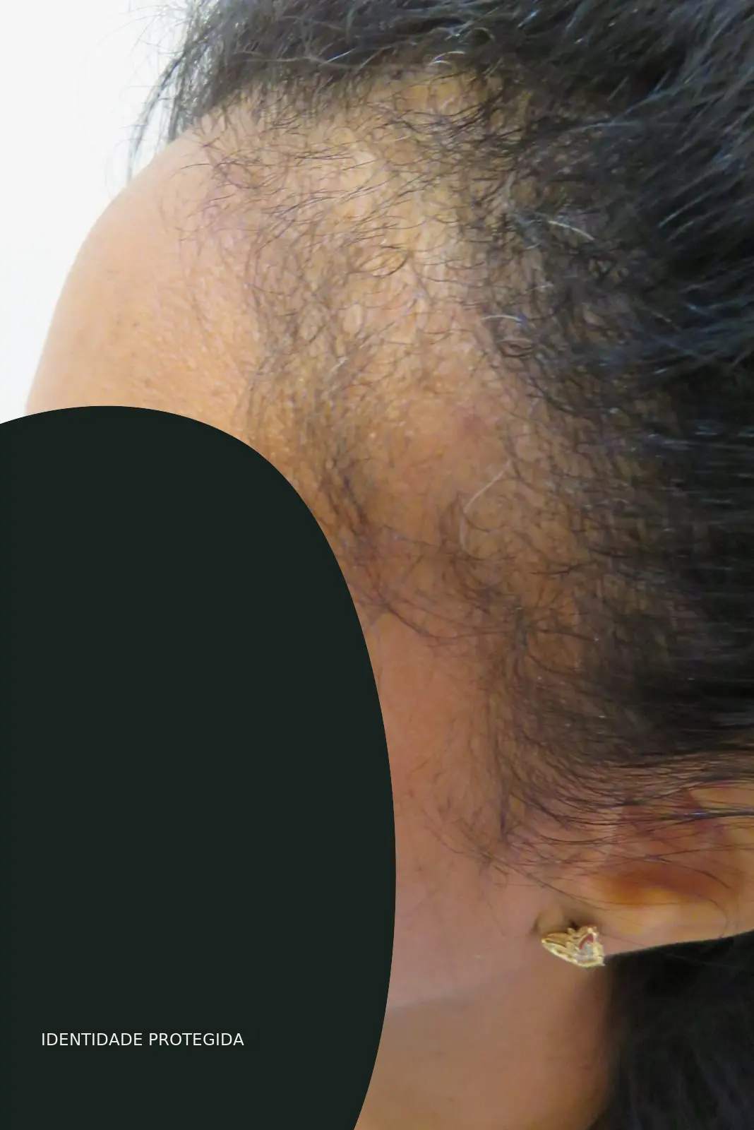Registro anterior anonimizado do caso 01, na região temporal e linha frontal