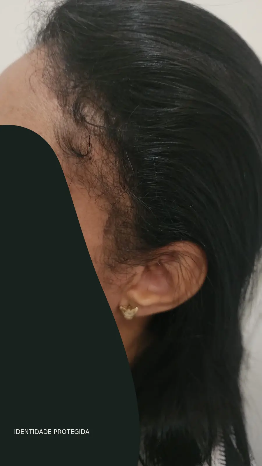 Registro posterior anonimizado do acompanhamento do caso 01, na região temporal e linha frontal
